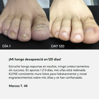 GEL TRATAMIENTO ANTIFÚNGICO